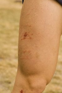 A close up of Emily’s right thigh is shown showing multiple cuts and abrasions.